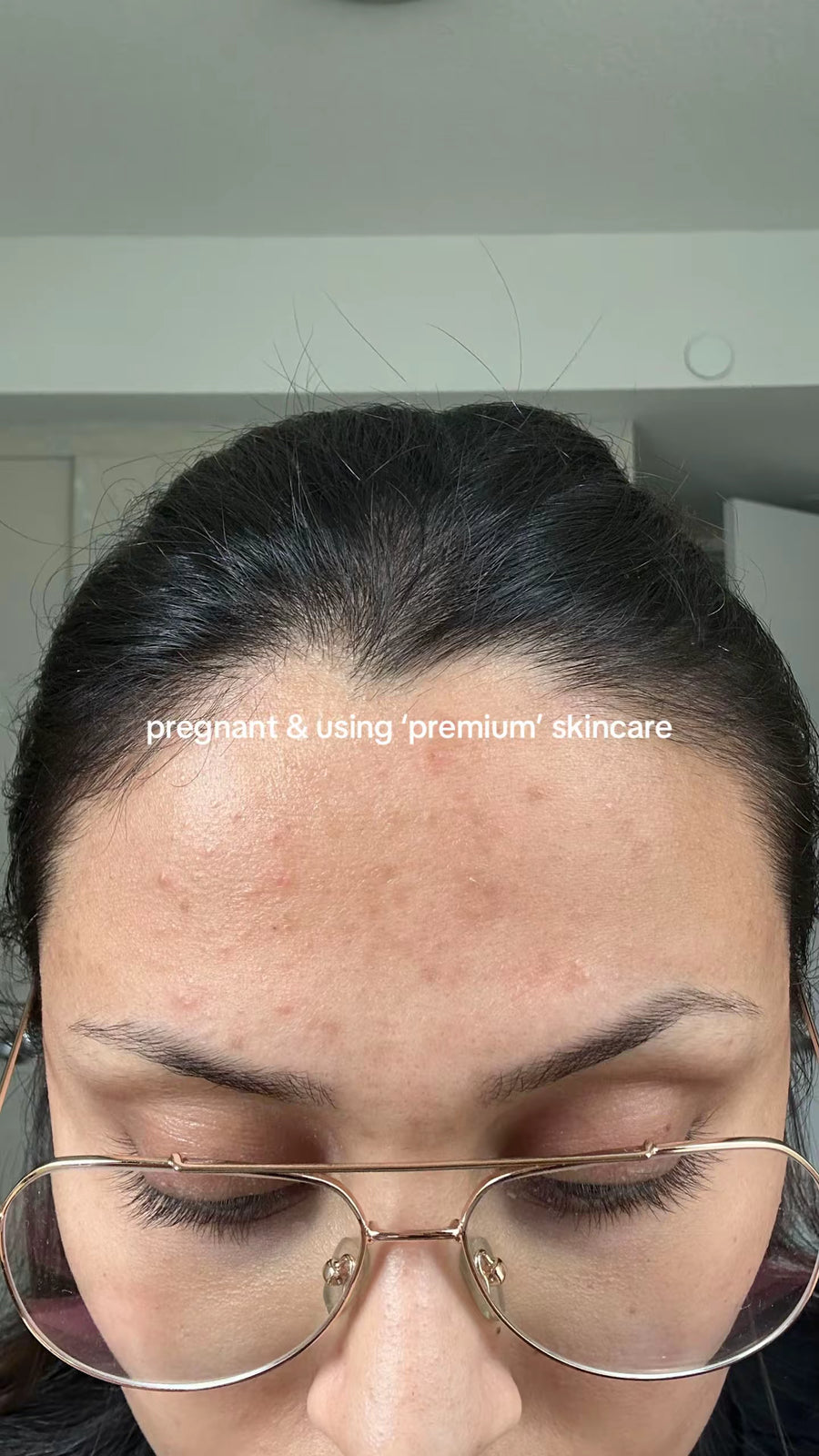 Pregnant, using 'premium' skincare — breakouts on forehead