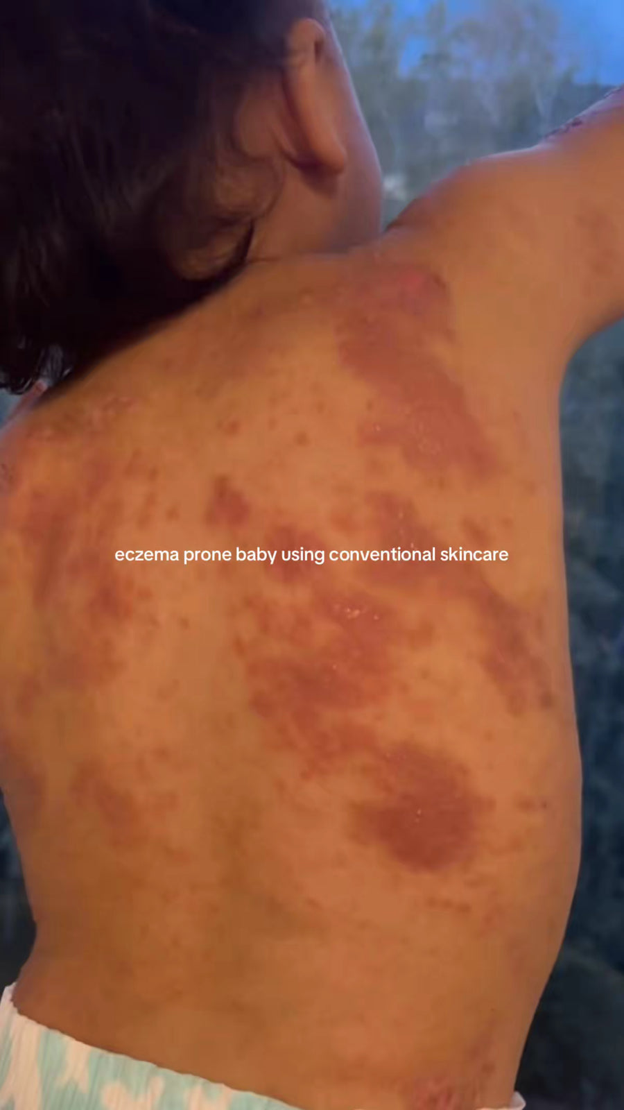 Eczema-prone baby's back using conventional skincare, red patches visible