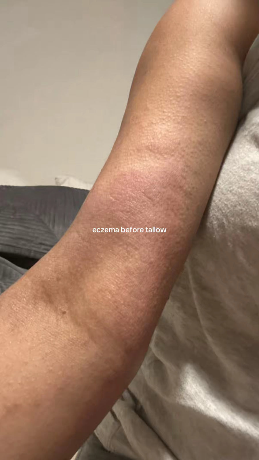 Adult forearm eczema before tallow