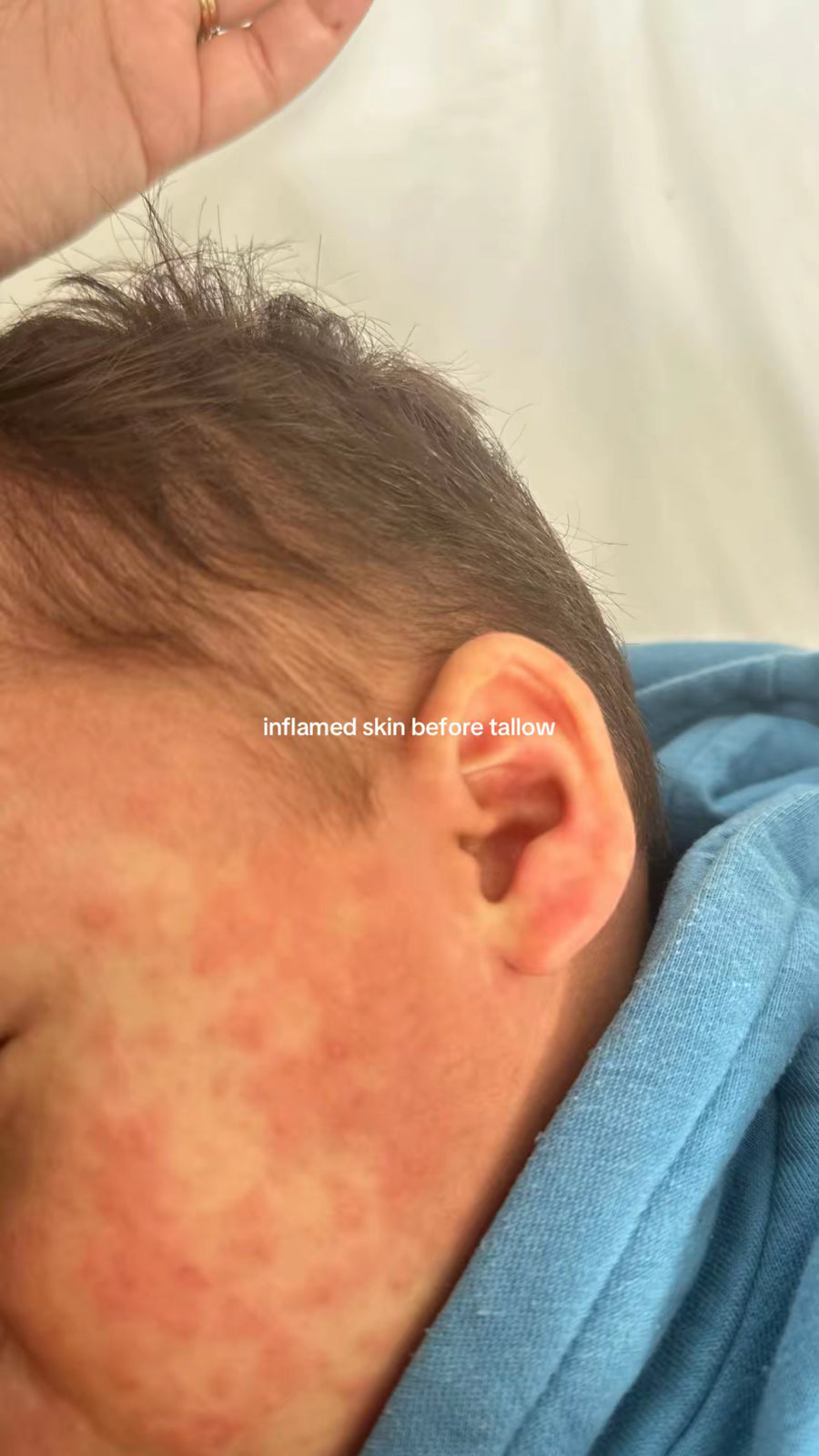 Baby's inflamed cheek before tallow