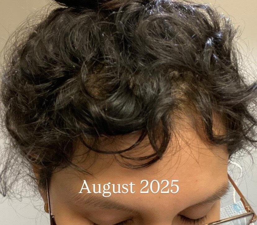 Same hairline in August 2025, filled in with new growth