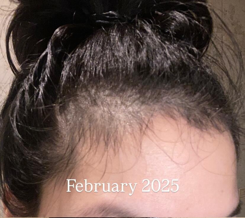 Postpartum hairline in February 2025, thinning at the temples